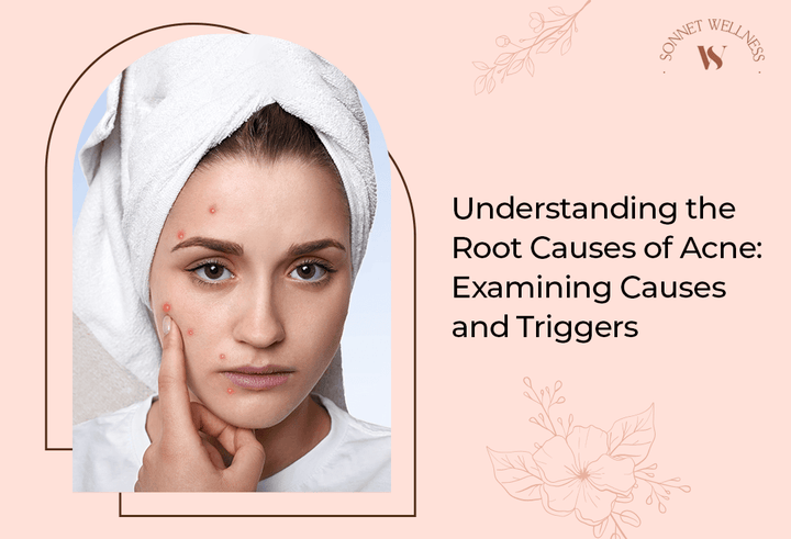 Understanding the Root Causes of Acne: Examining Causes and Triggers